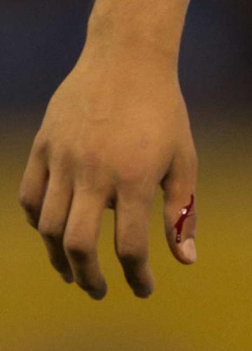 ＜レンジャーズ・マリナーズ＞７回、前回登板時と同じ右手の親指を傷つけ、血が流れだしたダルビッシュ
