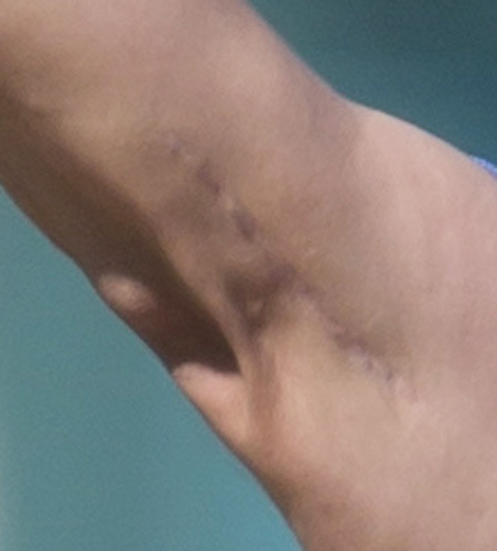 ダルビッシュの右肘に残る大きな手術痕