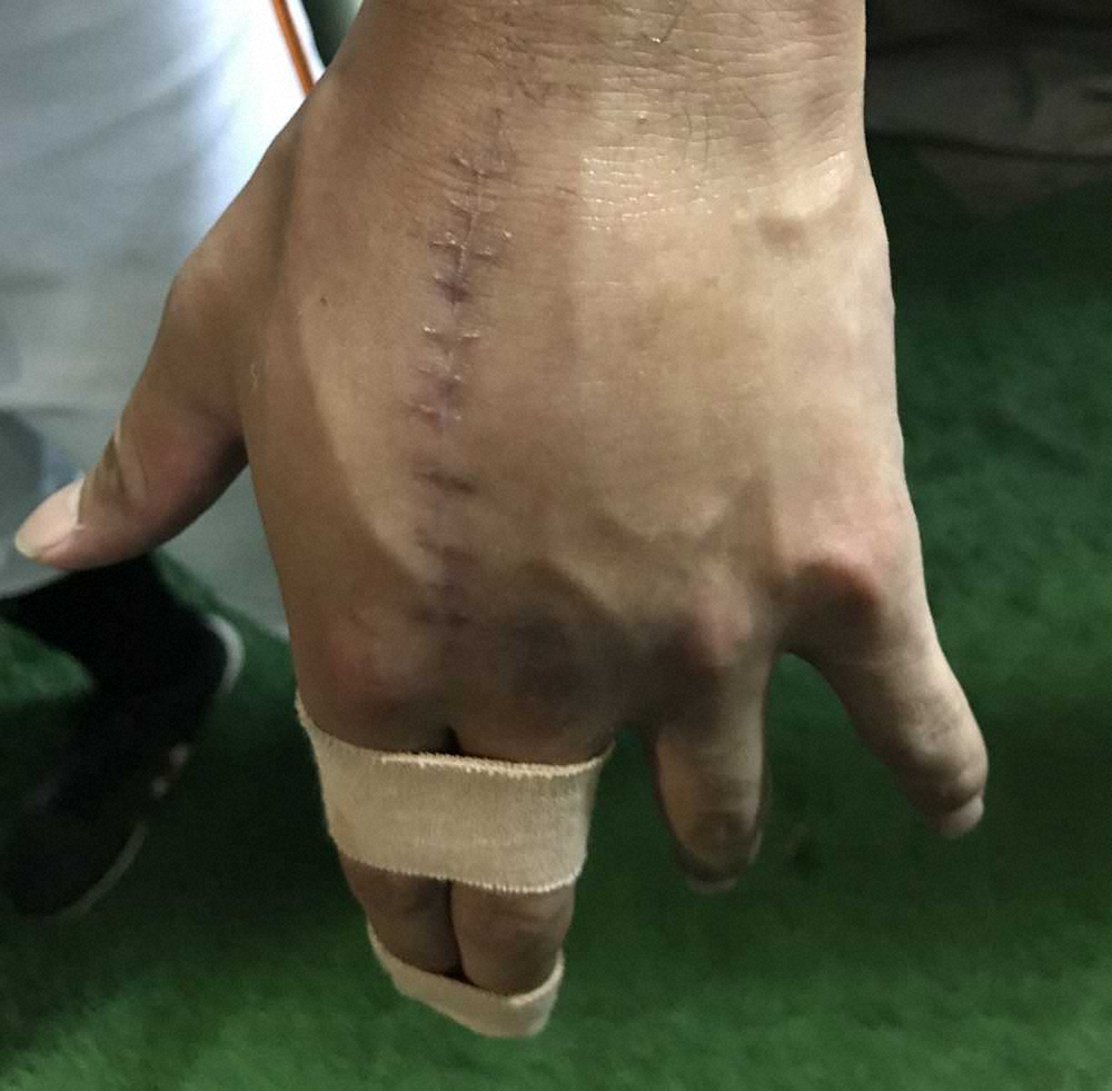 【画像・写真】巨人・吉川尚の手術直後の左手（18年9月撮影）