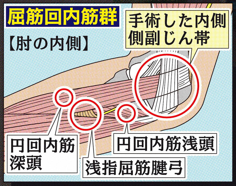 【画像・写真】トミー・ジョン手術の権威・古島医師が診断分析　制球悪く力んで筋肉に疲労生み…軽度なら打者は問題なし