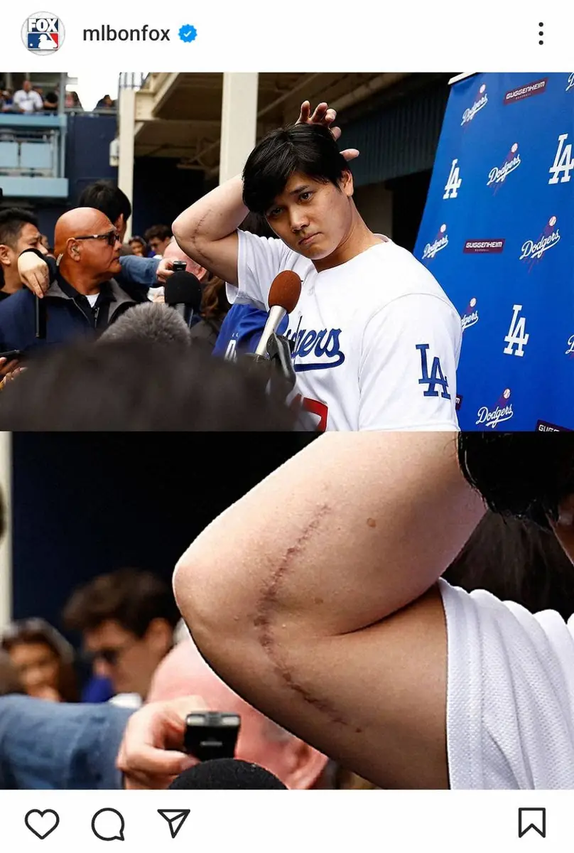 【画像・写真】大谷翔平　右肘手術痕が露わに　米「FOX Sports」が掲載　本人は「打つのはもうすぐ…」と話す