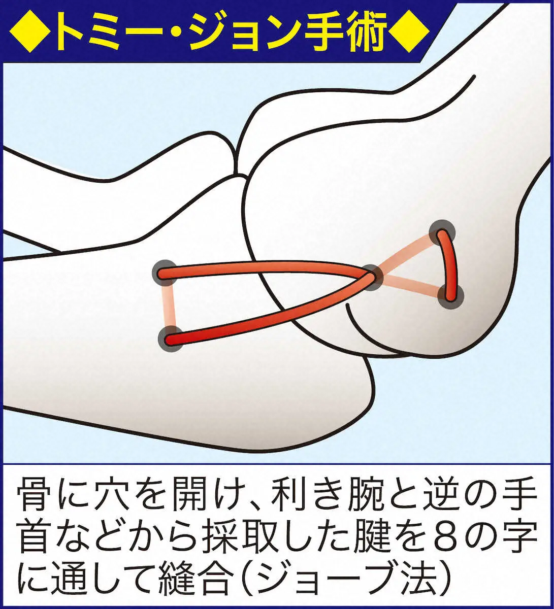 【画像・写真】トミー・ジョン手術ってぶっちゃけ費用はどのくらい？　元ソフトバンク球団幹部「だいたい…」