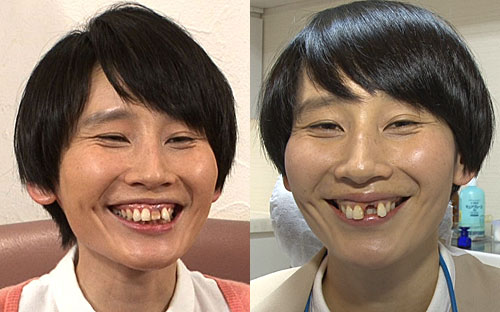 黒ずんだ前歯（左）を白くするため、歯を抜いた（右）箕輪はるか。この後、白い歯がはめられる（Ｃ）ＴＢＳ