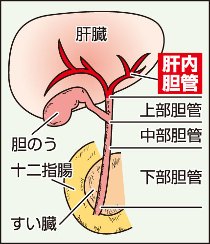 【画像・写真】肝内胆管がん　柔道の斉藤仁さんも…ごく細く腫瘍が見つかりにくい