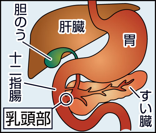 【画像・写真】医師見解　十二指腸乳頭部がんは「早期回復見込める」