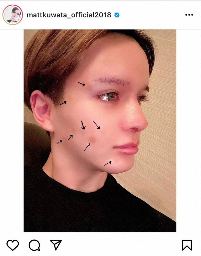 【画像・写真】Matt　ホクロ除去し術後のすっぴん披露　フォロワー仰天「本当にすっぴん？」「美しすぎ」