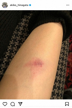 雛形あきこ 転倒し ストッキング越しにも分かる傷 痛そう キスマークかと スポニチ Sponichi Annex 芸能