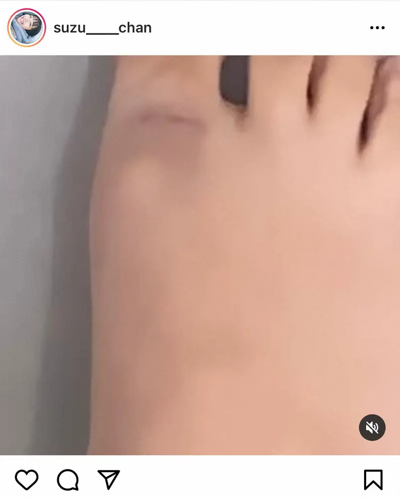 【画像・写真】山之内すず　足が青紫に変色「お皿を落としました」に心配の声「早く冷やして！」「お大事に」