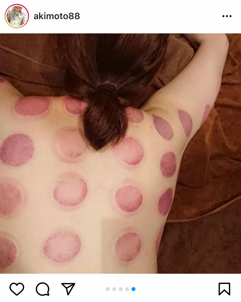 【画像・写真】痛くない!?大友愛さん、初カッピングした後ろ姿に「インパクトある」「スタイル抜群」「何か怖っ」の声