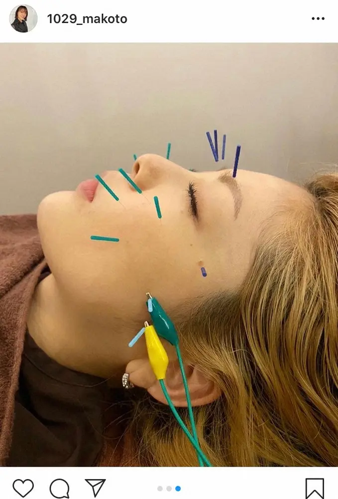 【画像・写真】小川麻琴　「効果を実感出来るって嬉しい」顔に美容鍼を刺した姿を公開
