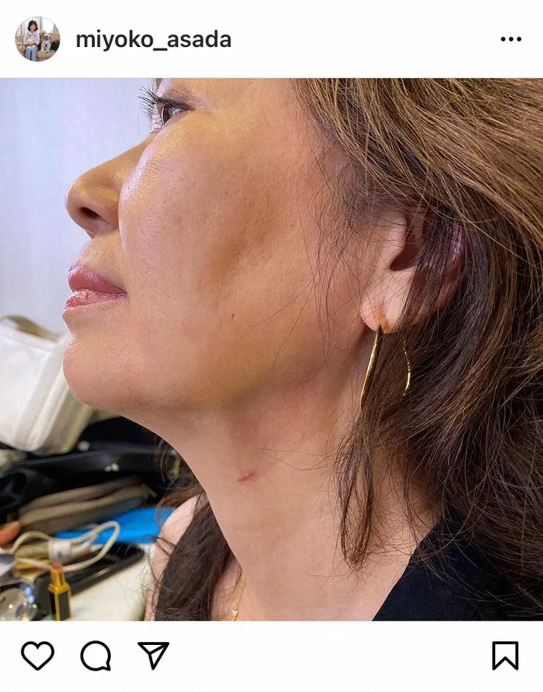 【画像・写真】浅田美代子　首のホクロ切除し、病理検査へ「結果が出るまでドキドキでしたが良性でした」