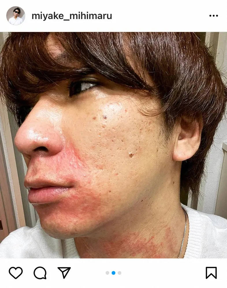 【画像・写真】mihimaru　GT・miyake「夏から口の周りに炎症」悩まされる肌トラブルに悲痛「誰か助けて」