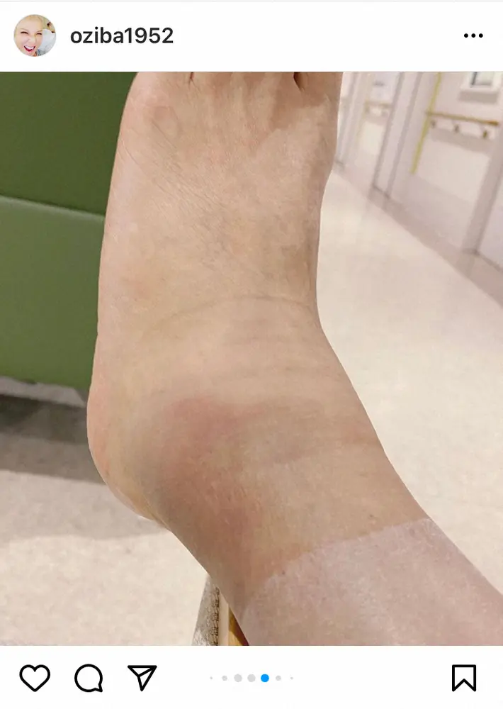 【画像・写真】池畑慎之介　ゴルフで転倒し左足首骨折で手術へ「足首のずれもあり手術しなければ治り方が遅くなると」