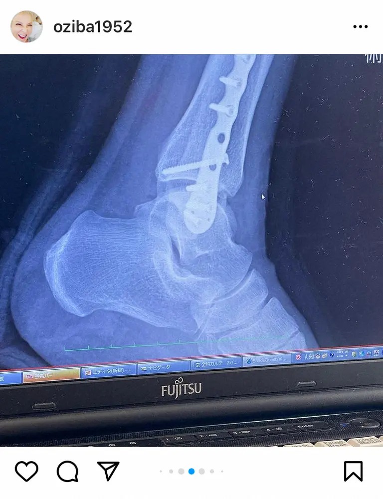 【画像・写真】池畑慎之介　22日に退院へ「チタンプレート入れて、ビス8本　震えます…」　ゴルフで転倒し左足首骨折