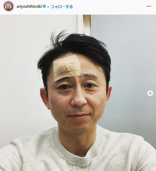 【画像・写真】有吉弘行、おでこの脂肪腫摘出から2年　今度は逆サイドに膨らみが「また取らなきゃいけないのかな…」