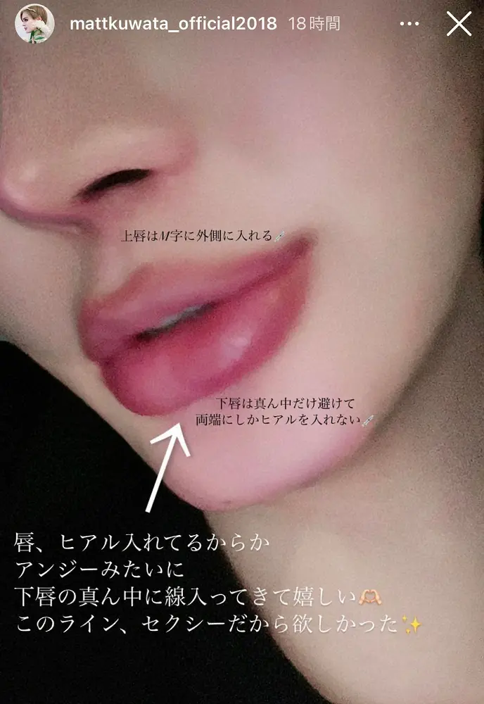 【画像・写真】Matt、ヒアルロン酸入れた唇のドアップ公開「アンジーみたいに線入って嬉しい」　ネットは「凄い」