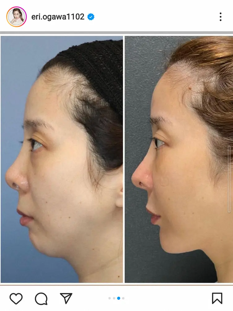 【画像・写真】元一流キャバ嬢タレント・エンリケ「整形して良かったなって」ビフォーアフター写真と施術内容公開