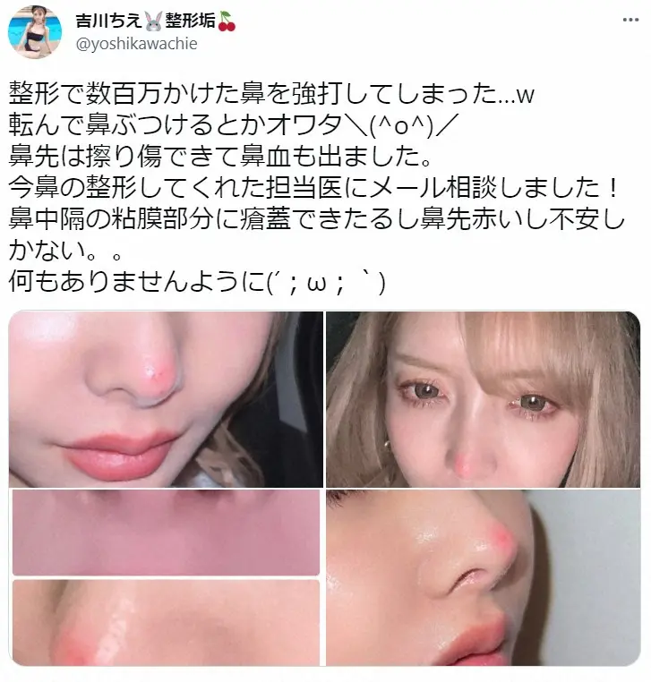 【画像・写真】双子モデル・吉川ちえ「整形で数百万かけた」鼻を強打「オワタ…」　整形総額1000万円超えを公言