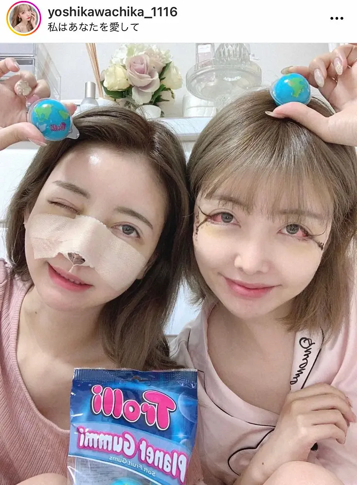 【画像・写真】4000万円かけて整形した双子モデル、過去の誹謗中傷を告白「バケモノ、グロイとか結構叩かれちゃった」