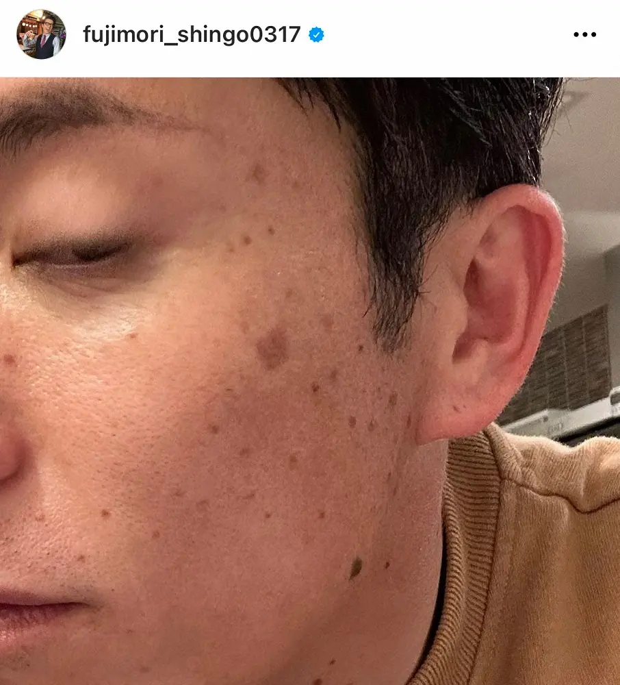 【画像・写真】オリラジ藤森のドアップに「イケメン…」「目の保養」ファンため息　シミ取りビフォーアフターが反響