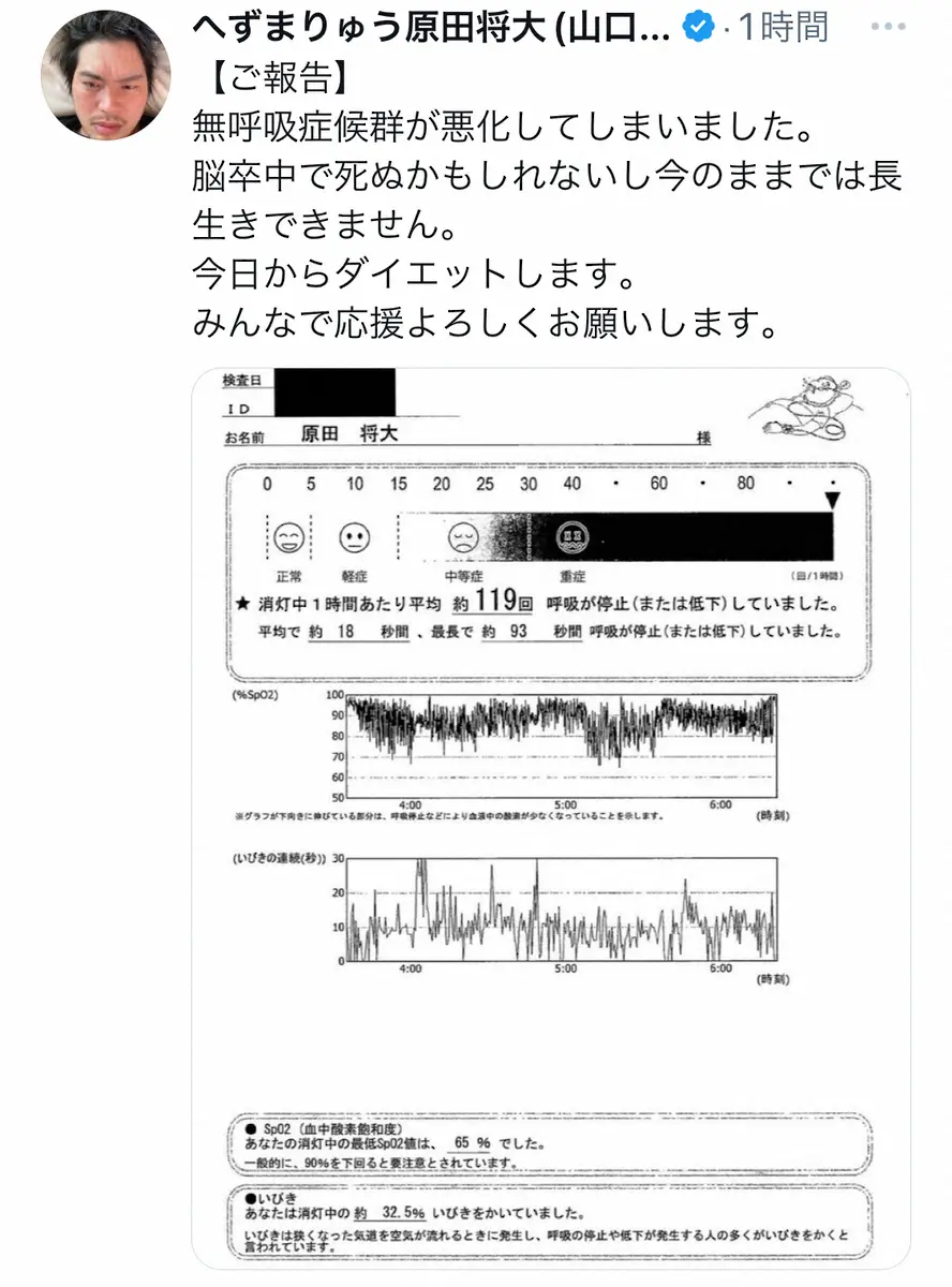 【画像・写真】へずまりゅう　無呼吸症候群の悪化でダイエット宣言「脳卒中で死ぬかもしれないし…」