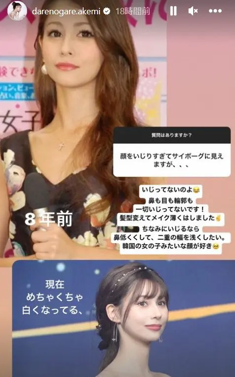 【画像・写真】ダレノガレ明美「顔をいじりすぎてサイボーグに見えます」指摘に反応　比較写真投稿し整形否定
