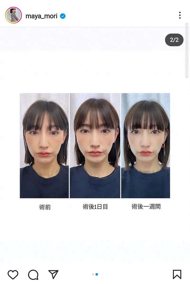 【画像・写真】森摩耶　ほうれい線にヒアルロン酸注入報告　術前＆術後の姿も披露「顔が引き締まりました！」