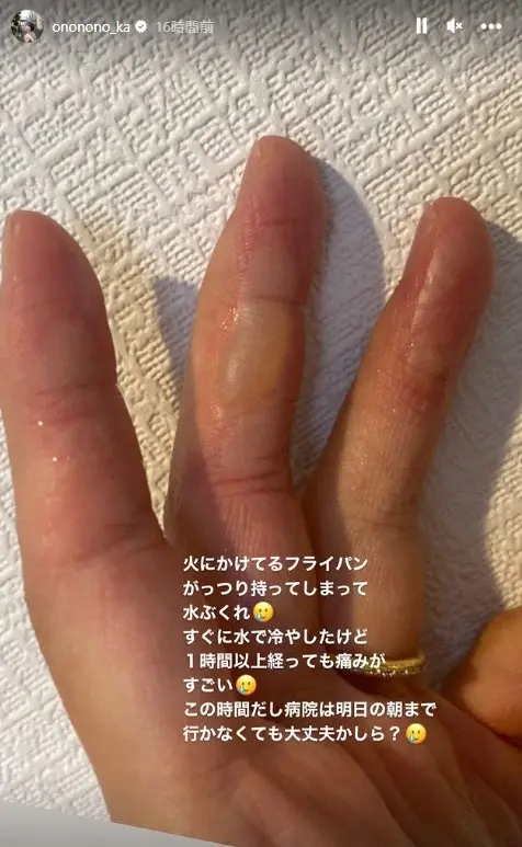 【画像・写真】おのののか、家事中に悲劇　痛々しい姿に…「1時間以上経っても痛みが凄い」朝イチで病院へ