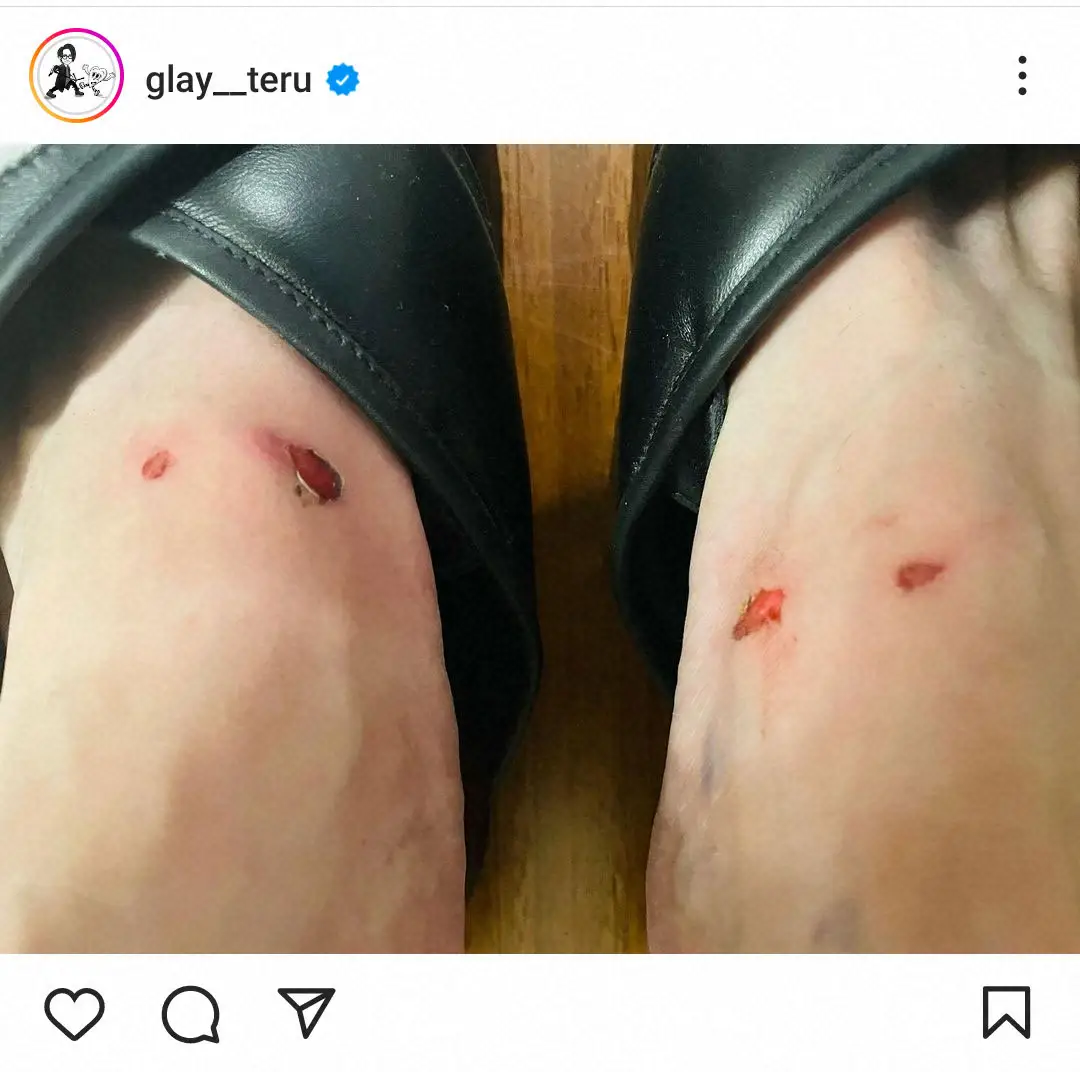 【画像・写真】サンダルで2時間歩いたら…GLAY・TERU、痛々しい足公開に心配の声「お大事に」「靴下履いて」