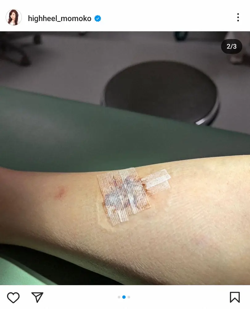 【画像・写真】足5針縫うケガしたモモコ「もう大丈夫」と抜糸を報告も「占いに足に注意と言われたん」