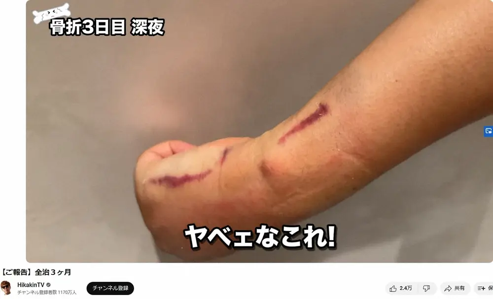 【画像・写真】ヒカキン、骨折で全治3ヶ月を報告　痛々しい“傷跡”にファン悲鳴…「本当に無理しないでください」