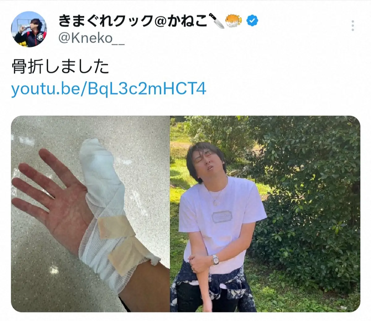 【画像・写真】人気ユーチューバー「きまぐれクック」かねこが人生初骨折「俺の大事な商売道具にヒビが」