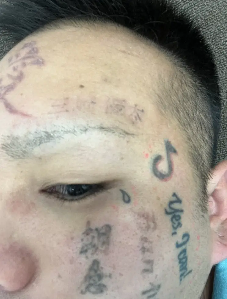 【画像・写真】顔面ニキ、タトゥー除去手術を受けたと報告「必要のない入れ墨は消させてもらう」社会貢献の妨げになると