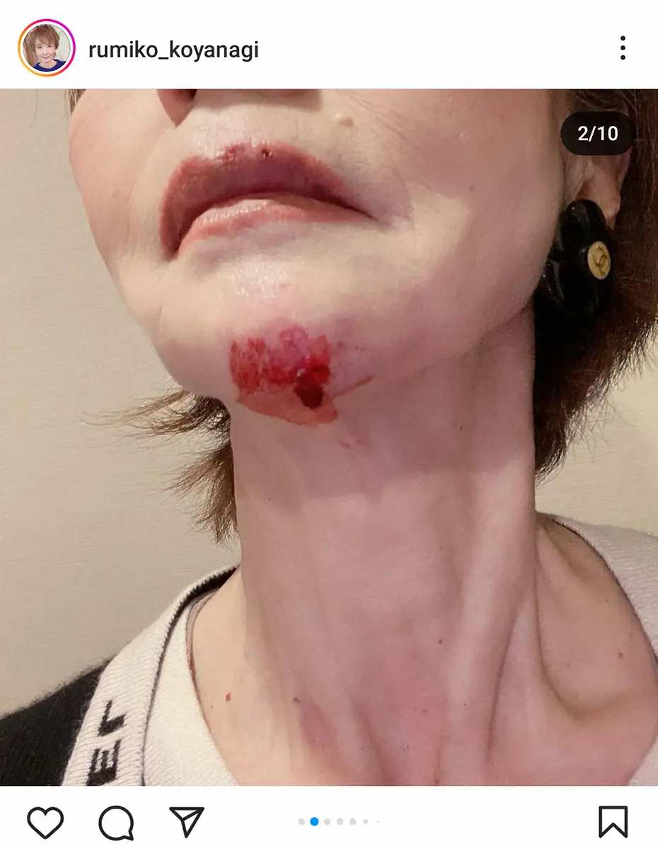【画像・写真】右手骨折の小柳ルミ子、痛々しい姿に心配の声　あごから流血「クリスマスにこんな写真をごめんなさいね」