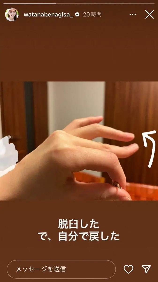 【画像・写真】休養中の渡邊渚アナ「脱臼した　で、自分で戻した」と左手写真を添えて報告　前投稿では心境の変化つづる