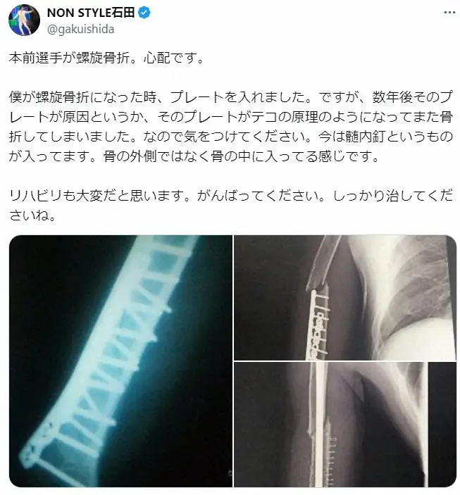 【画像・写真】ロッテ本前が救急搬送…「螺旋骨折」経験のノンスタ石田、痛々しい画像公開し説明　「これは怖い」心配の声