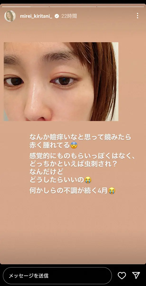 【画像・写真】桐谷美玲「多かった情報は・花粉・蕁麻疹・クインケ浮腫」　まぶたの腫れの原因は…「体質改善が必要かも」