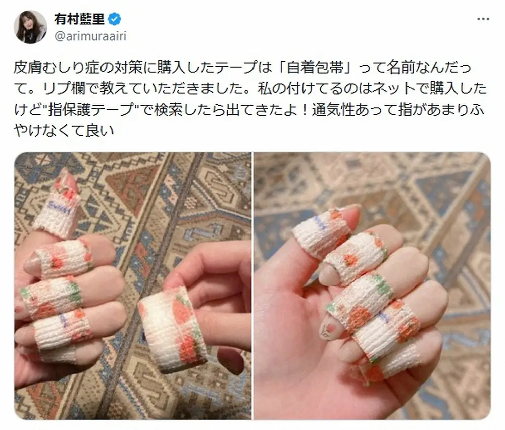 【画像・写真】有村藍里　“皮膚むしり症”対策明かす「これで改善されたらいいなあ」3年前に病名公表で反響