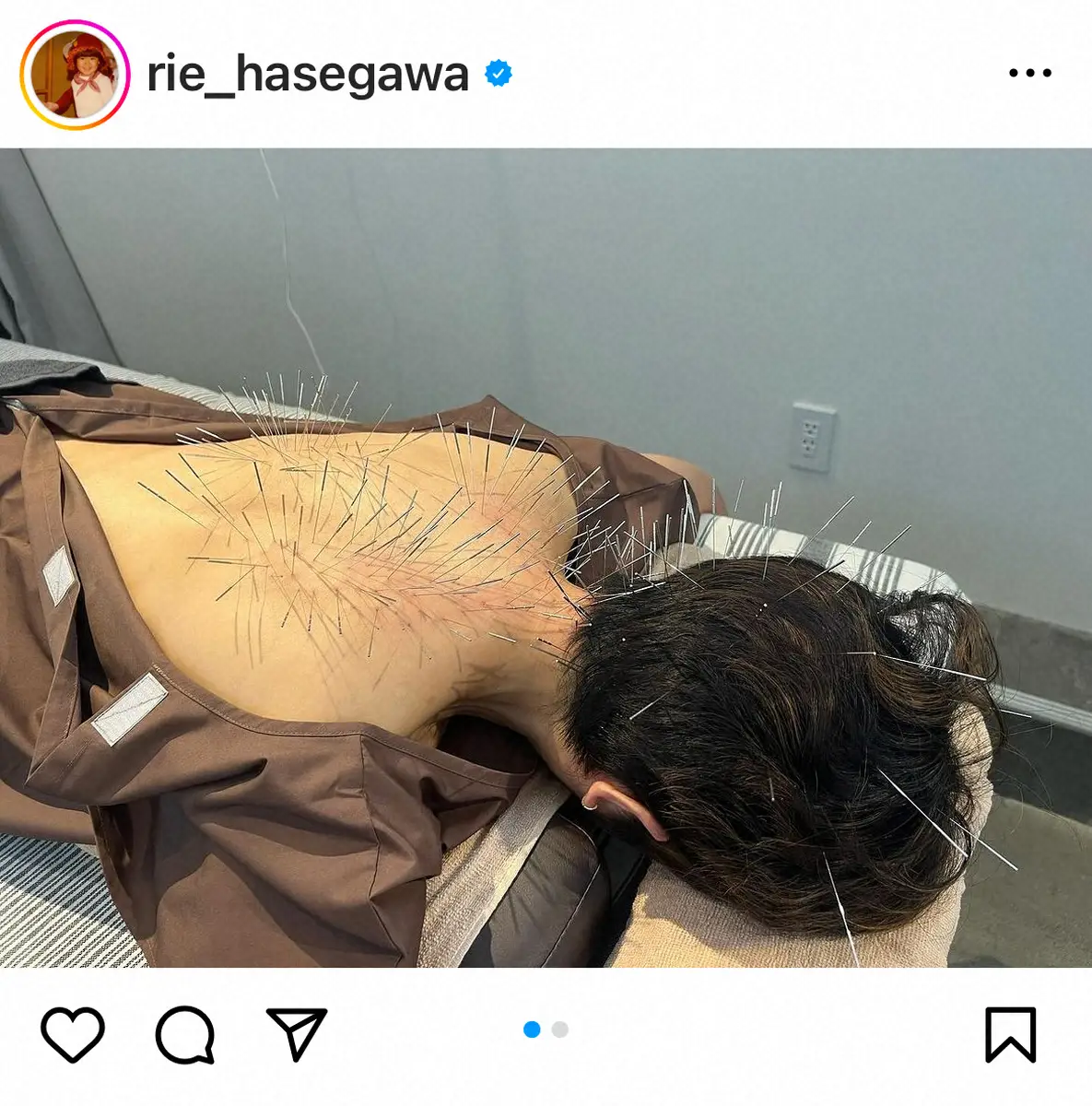 【画像・写真】長谷川理恵　「ハリネズミになった日」衝撃の鍼治療ショットにフォロワー「ちょっと怖すぎ」「すごい数」