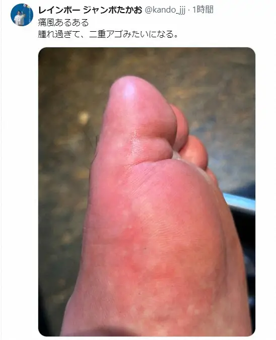 【画像・写真】34歳で「痛風」…人気芸人、異常に腫れた患部に衝撃の声「えッこんな風になるの！？」「その年でもう…」