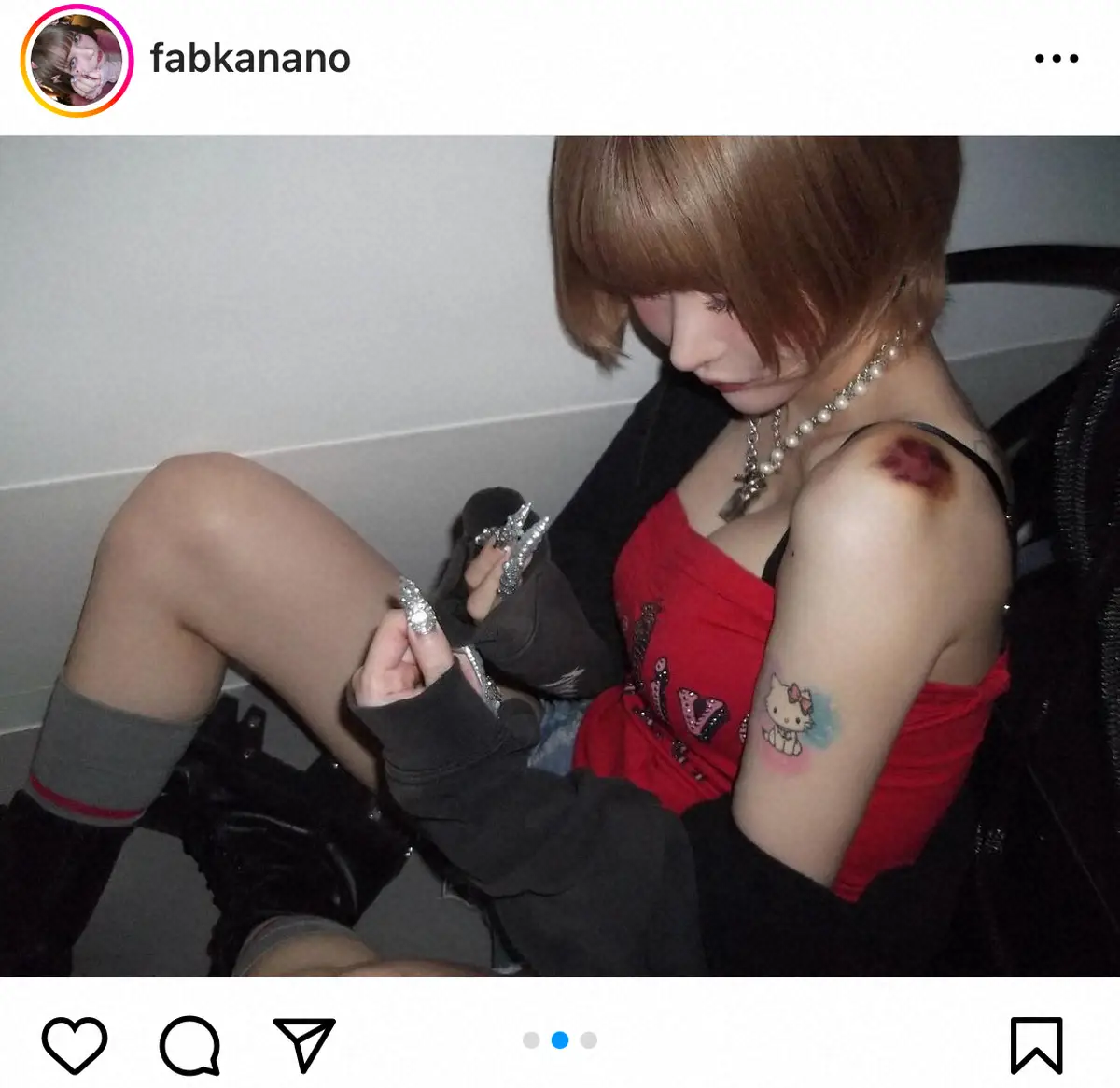 【画像・写真】戦慄かなの　緊急搬送されていた　赤黒い大きなアザ公開し心配の声「全部休もう」「頑張らなくていい」