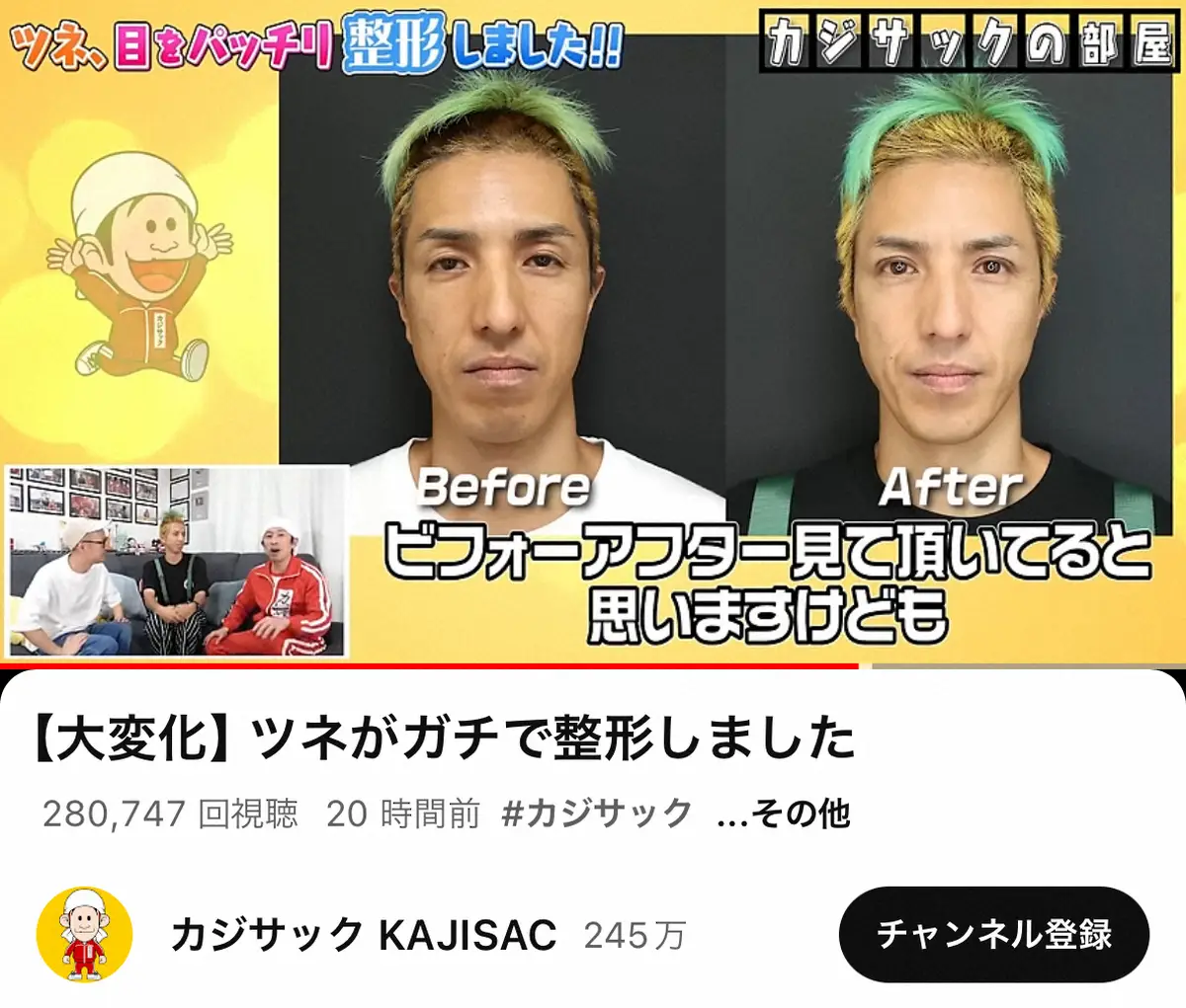 【画像・写真】元2700・ツネ　2度目の整形を報告「気分が全然違う！」　激変ビフォーアフターにカジサックも仰天