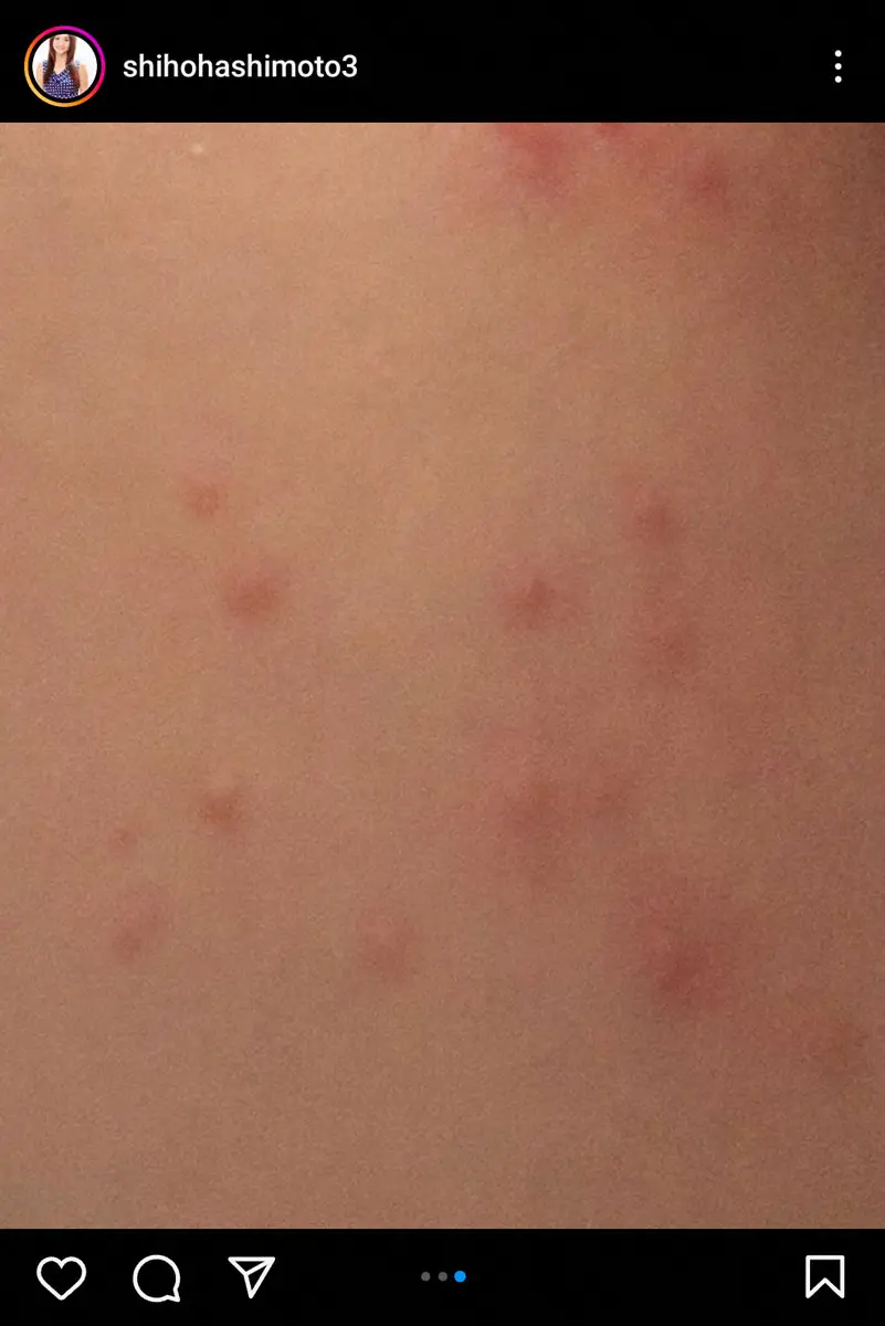 【画像・写真】橋本志穂　全身に謎の湿疹が現れ「かゆくて眠れず」病院へ…　まさかの診察結果に「え？」