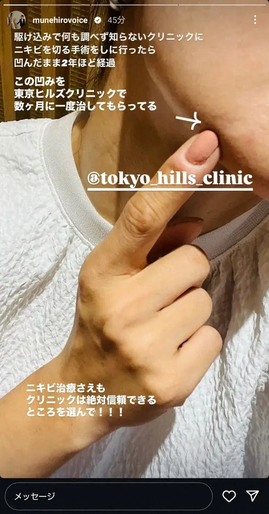 【画像・写真】鈴木紗理奈　ニキビ治療で受難「へこんだまま2年…」クリニック選びに警告「絶対信頼できる所を選んで」