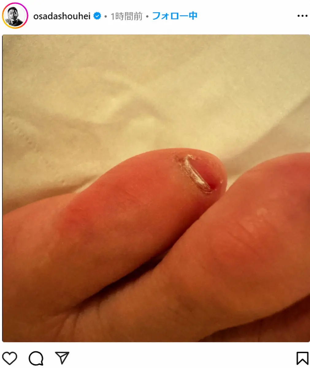 【画像・写真】チョコプラ長田　足の小指に起きた“悲報”に共感する声続々「全く一緒」「私も仲間」「わかりみ～」