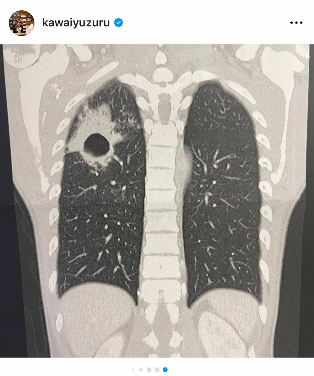 【画像・写真】河井ゆずる　肺に銃で撃たれたように開いた穴　肺膿瘍患ってから半年「ようやく塞がった」