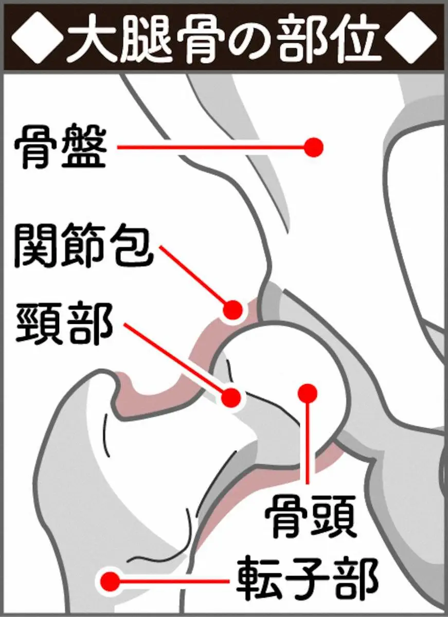 【画像・写真】「大腿骨骨折」予防　「ぬ」「か」「づけ」にご用心　認知症、うつにつながる「寝たきり」にならないために