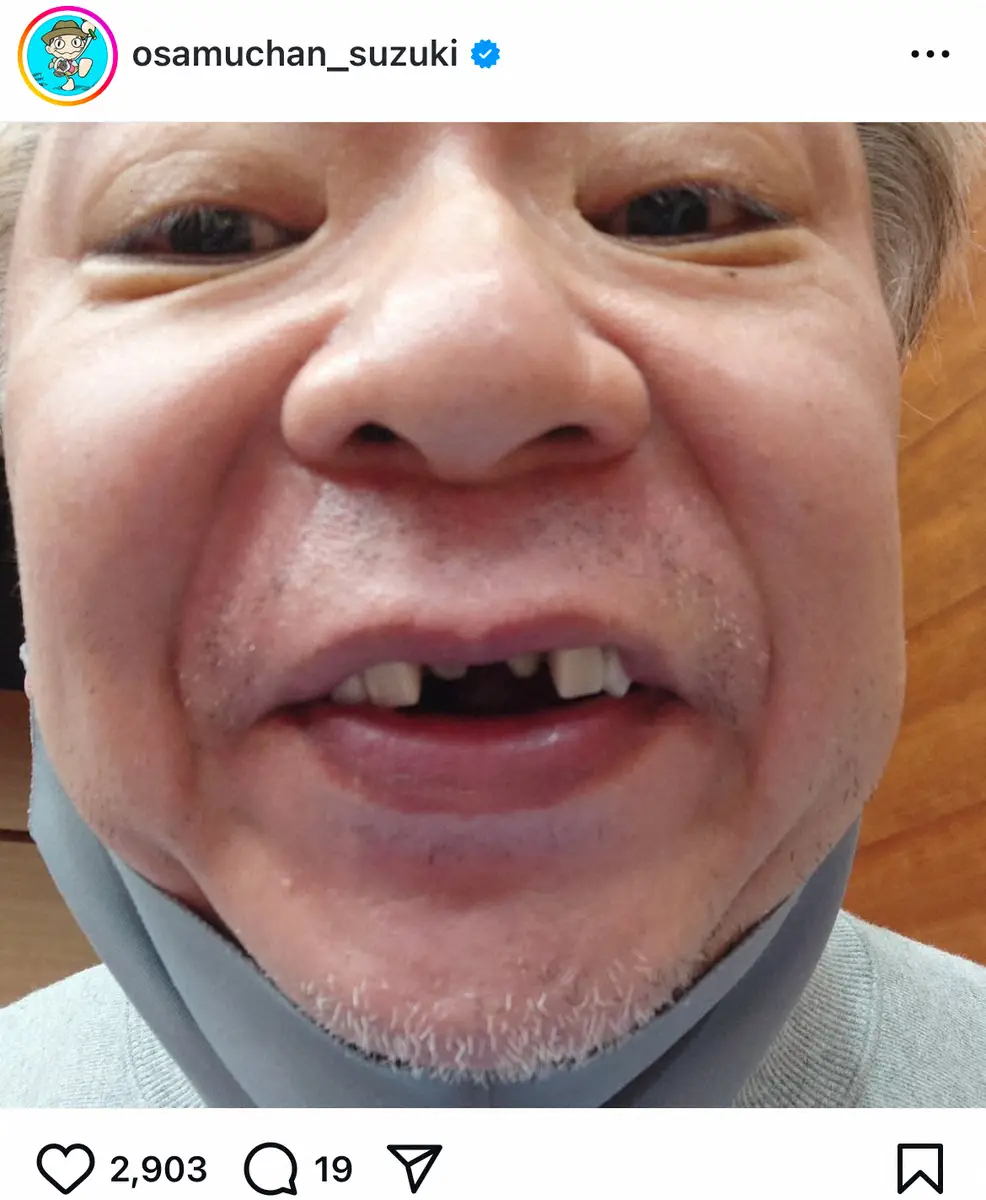 【画像・写真】鈴木おさむ氏「2本取れちゃった」前歯ないまま飲食店へ…まさかのもの食べられず「口の中で切れなーーい」