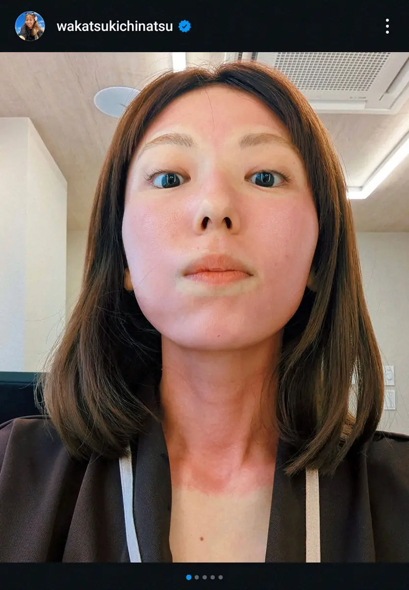 【画像・写真】若槻千夏　顔から首まで真っ赤！「レーザー強めにやってしまった」衝撃スッピン写真に「痛くないの？」