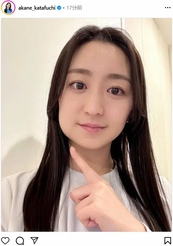 【画像・写真】片渕茜アナ「こんな顔になってしまいました」腫れた顔を公開も…「それでも奇麗」「半分安達祐実さん」